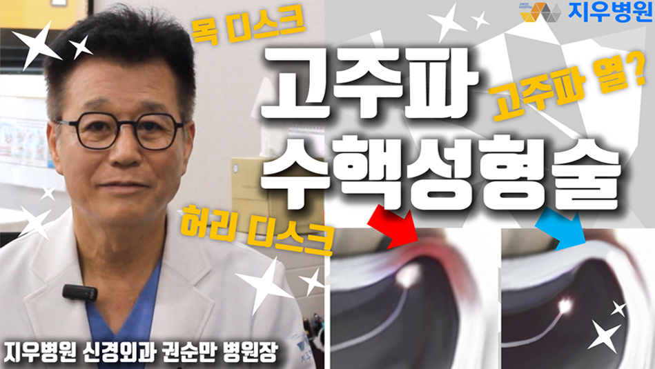 목ㆍ허리 디스크 치료, 고주파수핵성형술